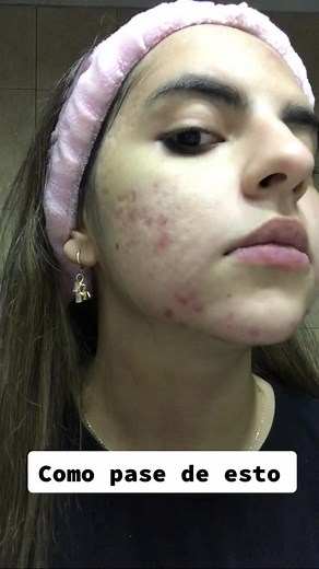 Acne Treatment Using Dead Sea Mud Face Mask