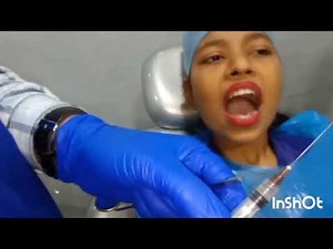 Live Demo of Root canal procedure part 1 By Dr Junaid Khan Dent-o-care dental clinic 9769177058