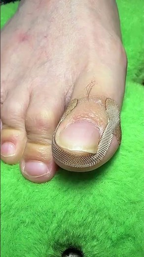 Ingrown Toenail Correction Hack Pain Relief & Nail Recovery Treatment Guide 💯