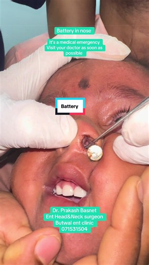 #foreignbodynose #foryou #viral #entdoctorbutwal #butwalentclinic | medical