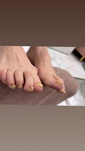 Before & After – Medical Pedicure When the nail becomes very thick,...