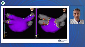 Prof Daniel Steven demonstrates how using the #Volt system with an HD Grid delivers clear lesion sets and immediate pulmonary vein isolation after PFA. Pre- and post-ablation maps reveal well-defined lines, with Volt enabling precision and HD Grid confirming isolation. Watch the full video here 🔗 https://ow.ly/pUb350WkqLX #VOLTPFA #EPeeps #PFA | Radcliffe Cardiology