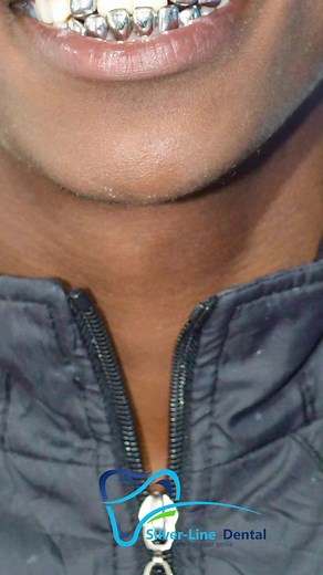 Permanent Silver Crowns - Everything You Need to Know