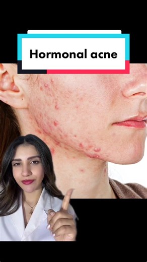 This type of acne is caused a rise in testosterone which may stimulate the excessive sebum production from the sebaceous glands. When this sebum combines with dirt, bacteria, and dead skin cells, it results in clogged pores and acne. #hormonalacne #fyp #jawlineacne