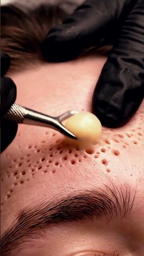 Clinical Forehead Comedone Extraction #Dermatology #asmr