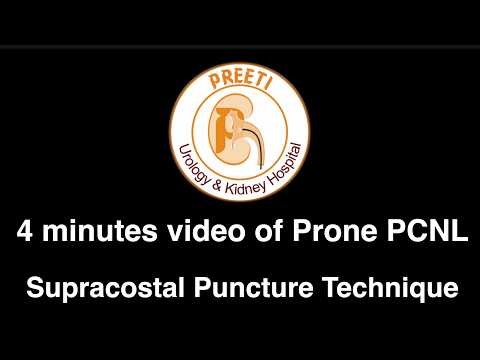 4 Minutes Video Prone PCNL – Supracostal Puncture Technique
