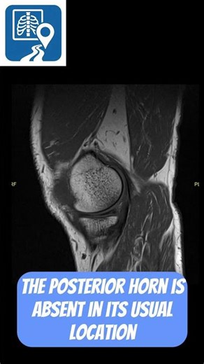 What’s Going On Inside This Knee MRI? #shorts #radiology