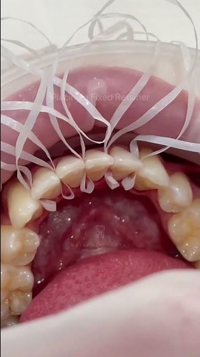 Placing a fixed retainer after Invisalign 🫶