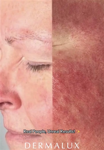 Effective Redness Relief Treatment Plan for Healthy Skin