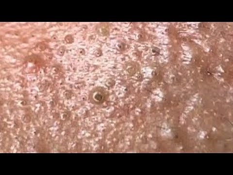 Deep blackhead extraction Cystic acne & pimple popping #30