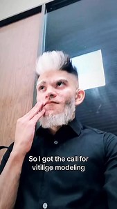 I want to become a model who represents the vitiligo community and shows that beauty comes in all shades and patterns. #vitiligo #model | Faizy Legend