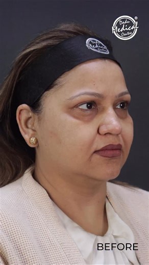 1.7K views · 11 reactions | Before & after: Lower face thread lift...