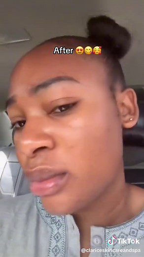 Glutathione Infusion Therapy: Before and After Results