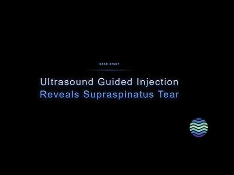 Ultrasound Guided Subdeltoid Bursa Injection Reveals Supraspinatus Tear | Case Study