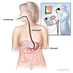 Upper Endoscopy — Integrated Gastroenterology Consultants