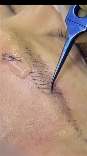 eyebrowplantingworkshop #eyebrowplantingvideo #植眼睫毛課程 #植眉毛教學 #植睫毛 #植发疤痕 #植眉植发植眼睫毛植胡子