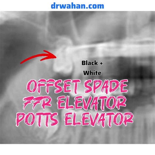 Using a Potts Elevator for Wisdom Tooth Removal