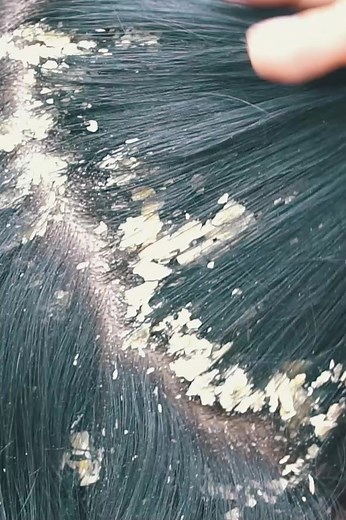 65K views · 93 reactions | Dandruff scratching | 33K | Facebook