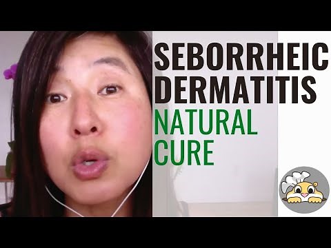 Treat Seborrheic Dermatitis Naturally - 3 simple tips