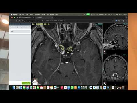 CONTOURING OPTIC CHIASM (ATTEMPT 1/3)