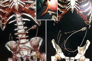 The fish gnawed its way through patient's intestines and created havoc in his belly