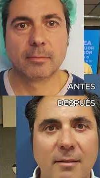 Blefaroplastia: tipos, anestesia y evolución del resultado