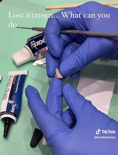 How to Recement a Dental Crown Safely