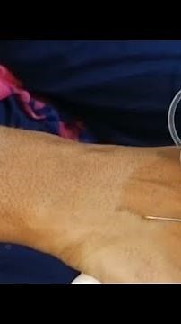 venipuncture using a butterfly needle