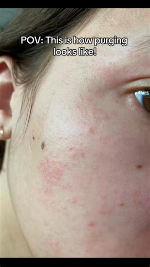 Starting retinol can cause dryness, purging, and irritation — but these are common and usually temporary. To minimize side effects, start slow, use a gentle moisturizer, and buffer your application. With consistency and patience, your skin will likely adjust in 4–6 weeks, revealing smoother, clearer skin over time. #Retinol #Retinoids #Purging #irritatedskin #retinoltips | Dr. Farzan