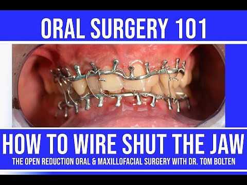 HOW TO WIRE SHUT THE JAW! | STEP by STEP LIVE INSTRUCTION | CLOSED REDUCTION with ARCH BARS