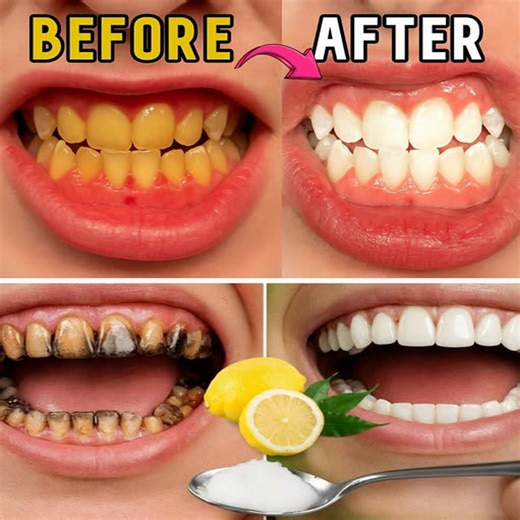 This will remove all the yellowness from your teeth and make them shine like diamonds. #TeethWhitening #teethwhitening #teeth | Pure Natural Recipes