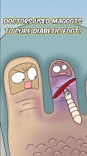 Doctors Used Maggots to Cure Diabetic Foot!?