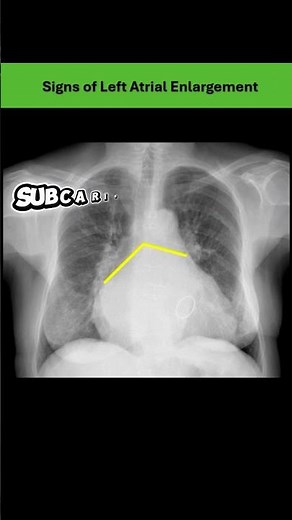 Left Atrial Enlargement: Key Radiological Signs on Chest X ray
