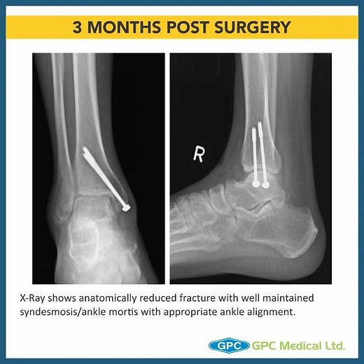Ankle Fracture Series: Management Technique for Medial Malleolar Fractures