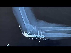 Examples of Common Fractures and Repairs