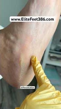 Dry pedicure. Clinical Pedicure. Waterless pedicure. Nail expert. Diabetic Foot Care. #pedicure