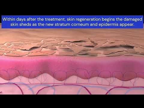 NeoGen Plasma | How NeoGen's Unique Nitrogen Plasma Technology Works