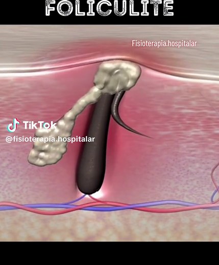 Foliculite: Sintomas, Causas e Tratamentos