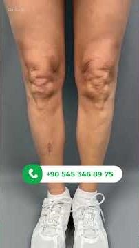 Calf Implant Week 1: Faster Recovery Than Expected!