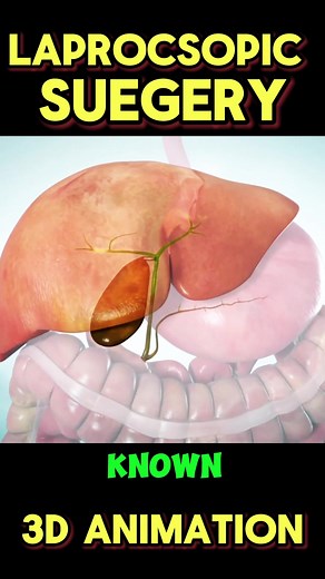 Gallbladder Surgery: Laparoscopic vs. Open Cholecystectomy Explained