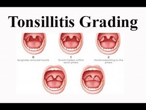 Tonsillitis Grading