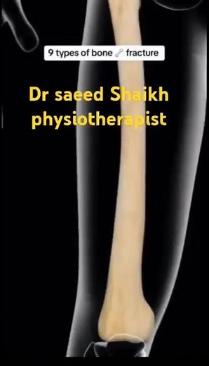 9 Common Types of Bone Fractures Explained | Causes, Symptoms & Treatment