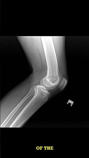 Knee X-ray Short: Normal or Not?