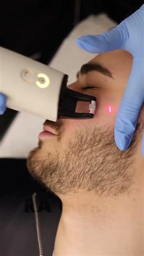 Rami Abadi Clinic | Frax Pro Laser Treatment to mprove Skin Texture, Pores & Collagen Renewal