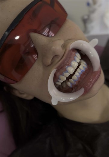 Bleaching ✨ #ortadent #dentistry #kosovo #teeth