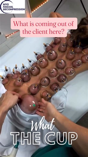 Myofascial Decompression: Movement and Loading on Instagram: "When is too much cupping too much for the body? Why your client should never look like this after a session… too many cups, for too long, at too high a pressure = dragon scales! This doesn’t decrease inflammation, it increases it 🐉 ⭕️ This will happen to almost every body if you leave the cups on for a long enough time at high pressure. Remember the viscoelastic properties of the extracellular matrix; high amounts of short term plast