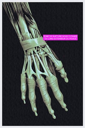 Rupture du tendon du long extenseur du pouce - Docteur Falcone