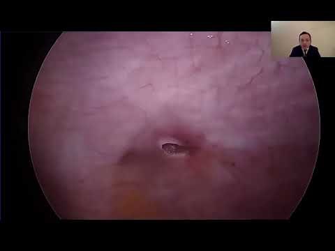 Laparoscopic-assisted transversus abdominus plane (TAP) block is equally effective in providing ...