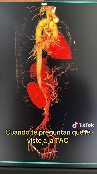 Análisis de una TAC médica: Lo que realmente se dañó y su reparación