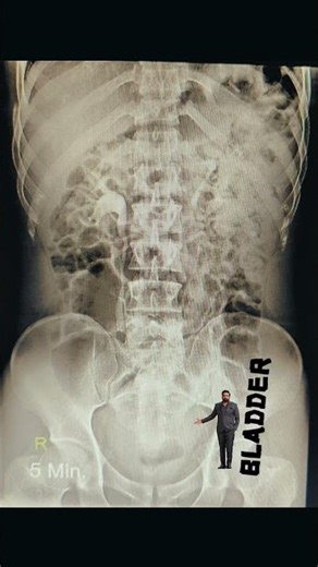 IVP PROCEDURE Both renal normal excretion